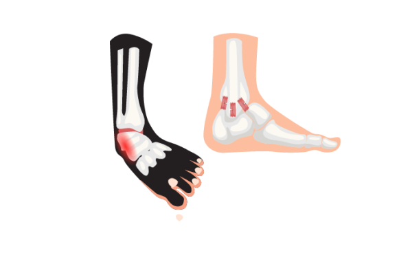 anklesprain